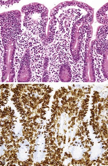 Tumors Of The Small And Large Intestines Including Anal Canal