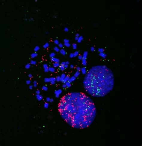 Extrachromosomal Dna Promotes Aggressiveness Of Small Cell Lung Cancer