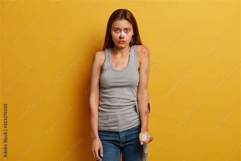 Health Problems And Insurance Concept Portrait Of Unhappy Woman With Broken Nose Scartches And