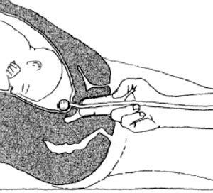 Simplified Foley Insertion For Cervical Ripening Mdedge Obgyn