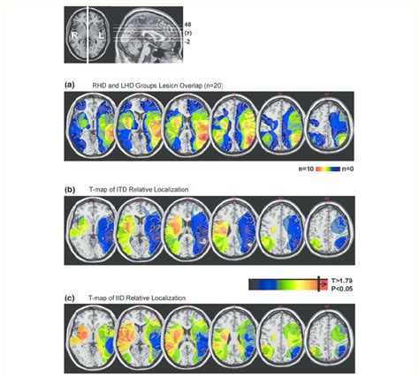 Voxel Based Lesion Symptom Mapping On The Subgroup Of Patients