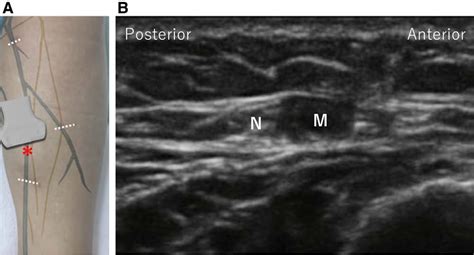 Figure 1 From Ultrasound Guided Hydrodissection Of An Entrapped Saphenous Nerve After Lower