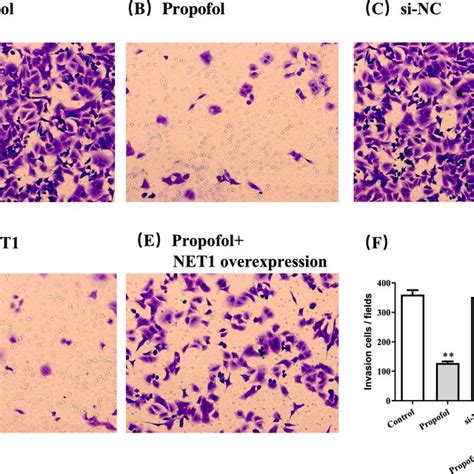 Aberrant Expression Of NET1 In Hepatocellular Carcinoma A B NET1