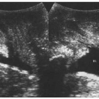 Grade II, cystocele and Grade II, prolapse of uterus. Arrows indicate... | Download Scientific ...