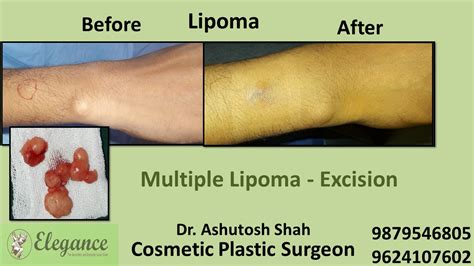 Lipoma Treatment In Bharuch Surat