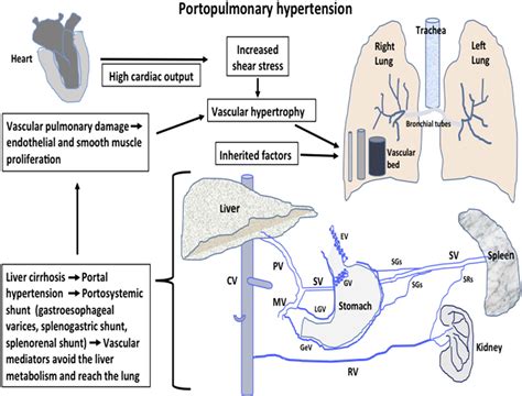 Portopulmonary Hypertension And Hepatorenal Syndrome Two Faces Of The