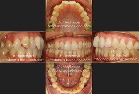 Tratamiento Con Invisalign Full Desviación De La Línea Media Y Ligera