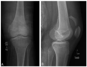 Osteochondral Fracture Knee