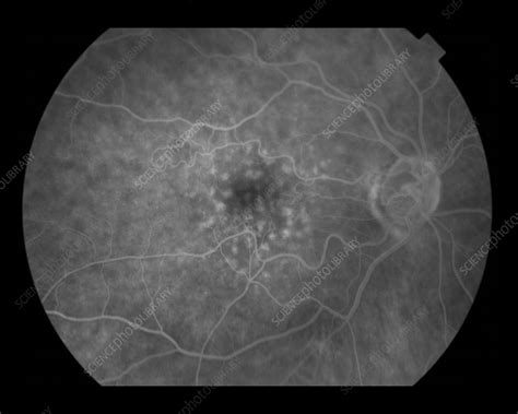 Dry Age-Related Macular Degeneration - Stock Image - C027/1471 - Science Photo Library