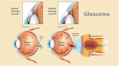 Glaucoma: Symptoms, Treatments, and Long-Term Outlook | 1MD Nutrition™