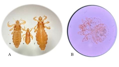 Pediculosis Capitis And Scabies In Nurses From Eastern Poland