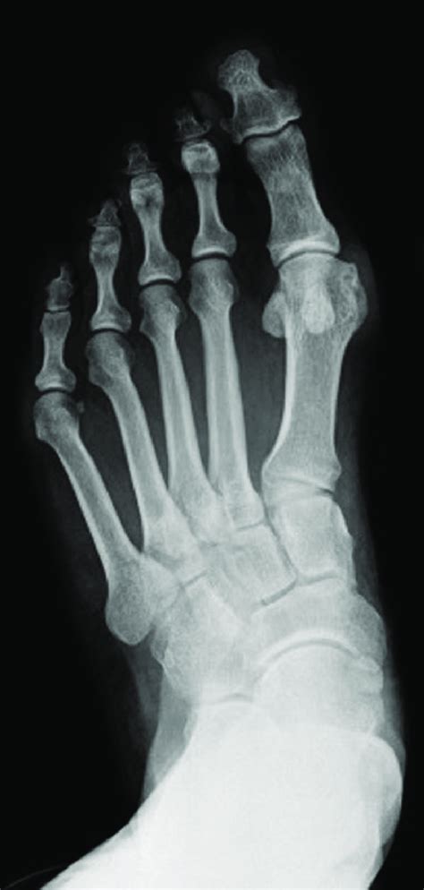 Left foot preoperative x-ray. | Download Scientific Diagram