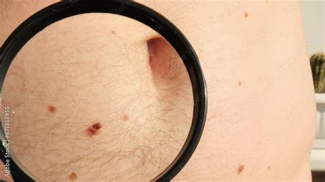 Mole Dermoscopy Preventive Of Melanoma Dermatologist Examining