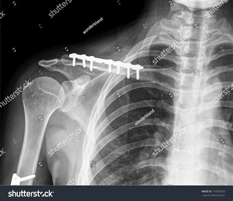 X Ray Collarbone Stock Photo 116074270 - Shutterstock