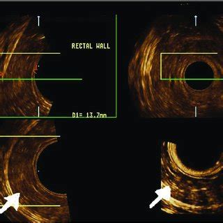 Three Dimensional Endoanal Ultrasound With Multiplanar Image Analysis