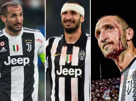 Gli Infortuni Choc Dei Calciatori Da Donnarumma A Chiellini Ai