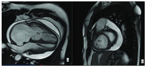 Steady State Free Precession Ssfp Cine Imaging By Cardiac Magnetic