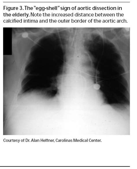 Aortic Dissection Signs And Symptoms