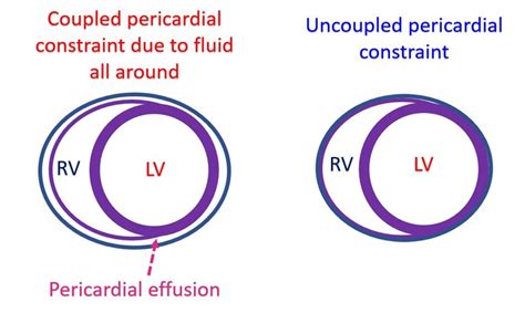 Concept Of Coupled And Uncoupled Pericardial Constraint All About