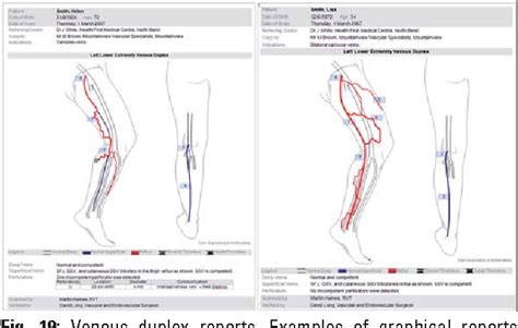 Figure 19 from Duplex ultrasound in the assessment of lower extremity ...