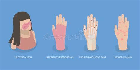 D Isometric Flat Vector Illustration Of Systemic Lupus Erythematosus