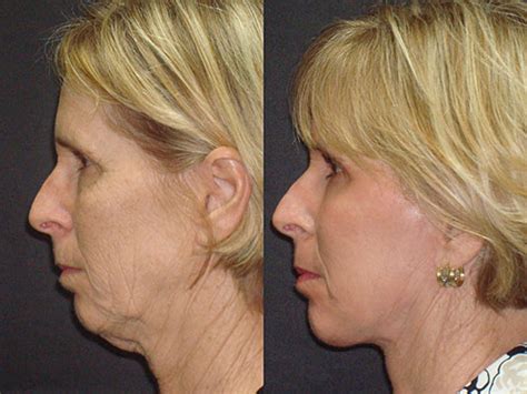 Lower Facelift Guide: What Are They, Cost, & Recovery