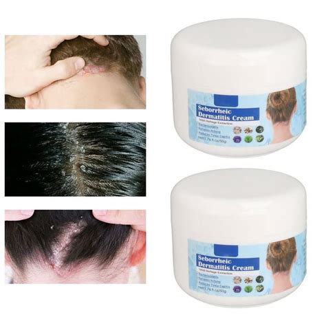 Seborrheic Dermatitis Cream Scalp Treatment Cream Pcs Mild Oz