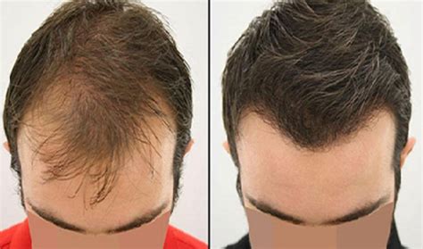 Hair Transplant Turkey - The Jerusalem Post