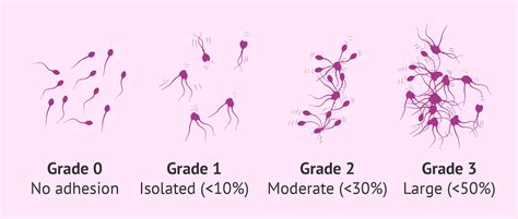 Degrees Of Sperm Agglutination