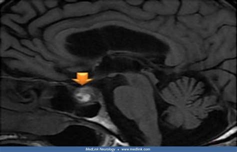 Pituitary apoplexy | MedLink Neurology