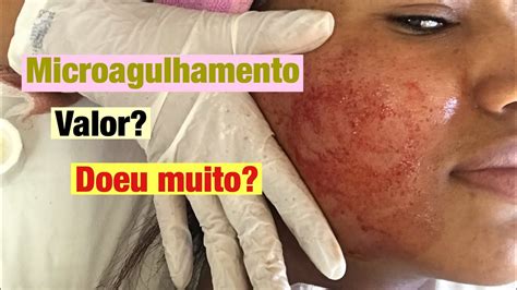 Microagulhamento Sessao Tirando Marcas De Acne Youtube