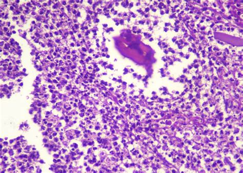 Pathology Outlines Chronic Osteomyelitis