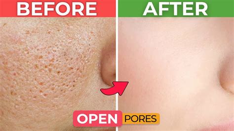 Open Pores Causes Home Remedies And Treatments Hash Clinics Youtube