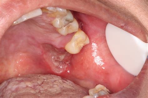 Figure 12 Palate A Large Suspicious Ulcer With Indurated Margins And