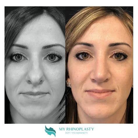 Rinoplastica Punta Naso Scopri L Intervento My Rhinoplasty