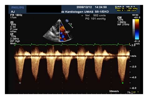 Estimation Of The Pulmonary Arterial Systolic Pressure PASP From The