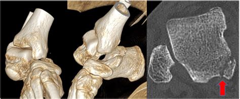 CT Of The Ankle And The Foot With 3D Reconstruction Confirmed The