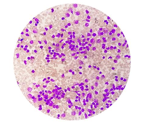 Premium Photo Blood Smear Under Microscopy Showing Chronic