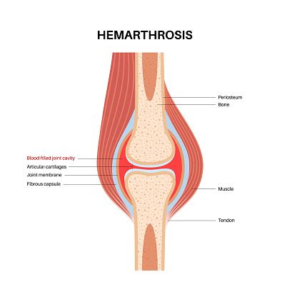 Hemarthrosis In The Synovial Joint Stock Illustration - Download Image Now - Anatomy, Biology ...