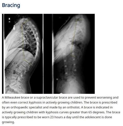 My observations on scoliosis and Kyphosis. – Dr.Jinhaeng Lee