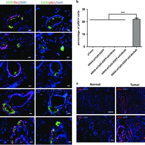 Cdkn B Inactivation Is Indispensable For Rb Phosphorylation Of Ductal