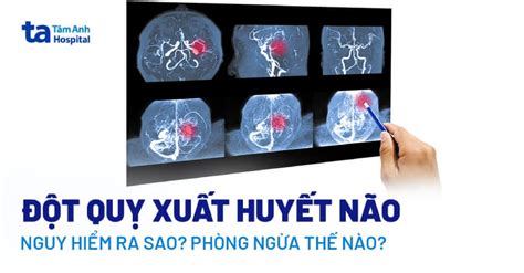 Triệu Chứng Đột Quỵ Xuất Huyết Não Nhận Biết và Xử Lý Kịp Thời