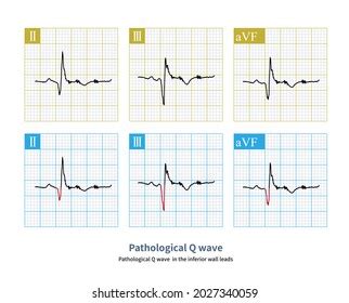 Pathological Q Wave Ecg Index Myocardial 库存插图 2027340059 | Shutterstock