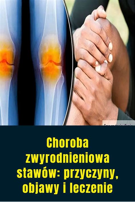 Choroba Rittera Przyczyny Objawy Leczenie Poradnikzdrowie Pl Mobile