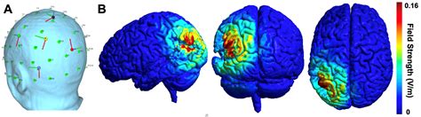 Aphasia Research Neurology Medical College Of Wisconsin