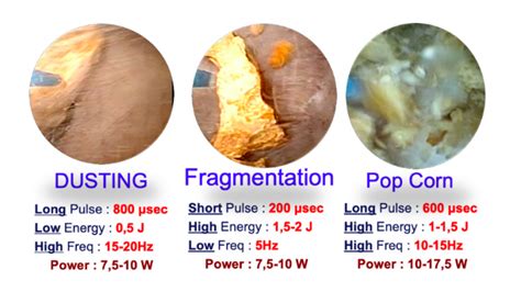 Laser Lithotripsy Principles Cau