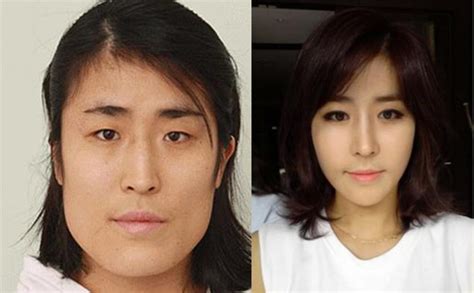 Korean Woman Gets New Face and a Fiancé Thanks To Amazing Plastic ...