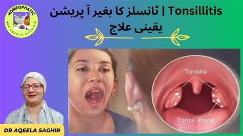 Tonsillitis causes and Solutions ٹانسلز کا بغیر آ پریشن یقینی علاج