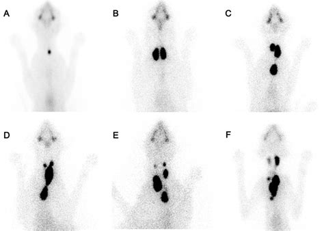 Thyroid Scintigrams Illustrating The 16 Areas Of 99mtco−4 Uptake In