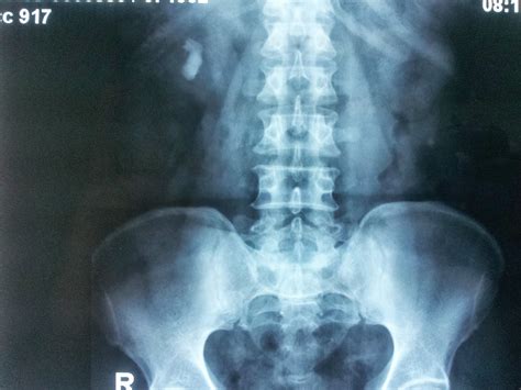 Ramayya Pramila Urology Hospital: PCNL IN LOWER CALYCEAL STONE